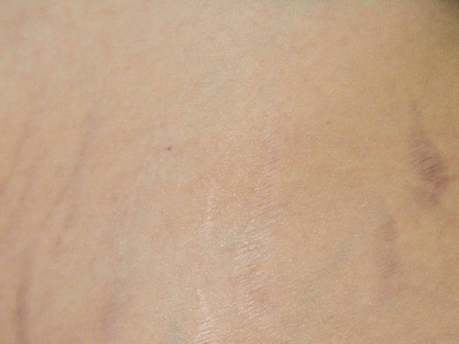 stretch mark cream results