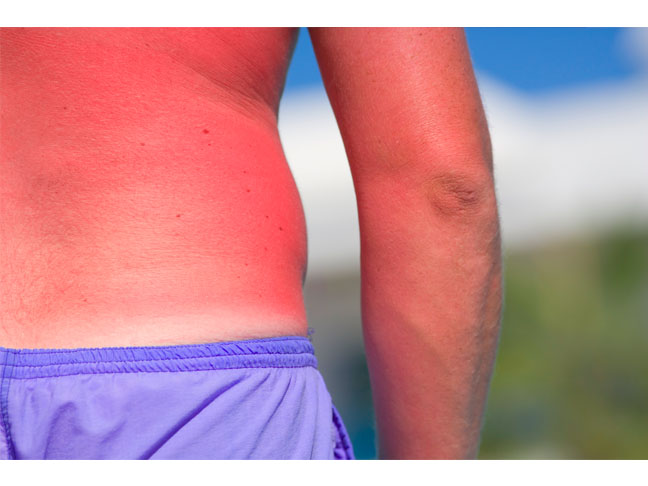 Help Treat a Sunburn